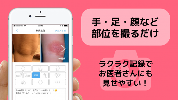 日本初の“アトピー治療見える化アプリ”をリリース　元アトピーのパパが無料iPhoneアプリ「アトピヨ」を開発！